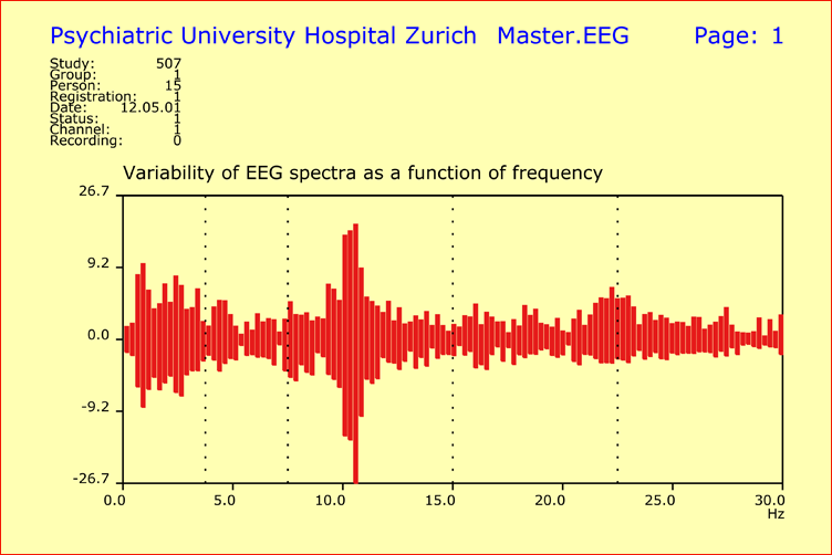 Mismatch Negativity in Schizophrenia